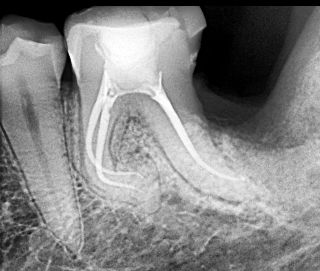 x ray of shaped canal with zenflex CM