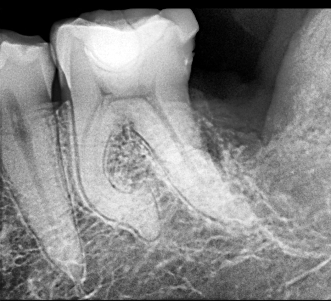 x ray of canal before being shaped zenflex CM